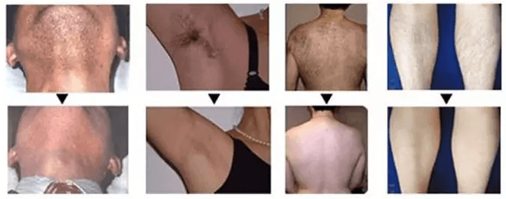 permanent laser hair removal at home
