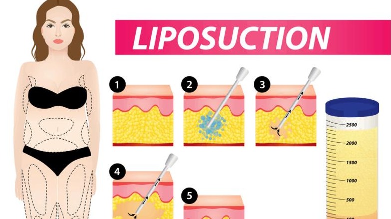 Vacuum Slimming Machine Ultrasound Lipolysis VS Surgical Liposuction